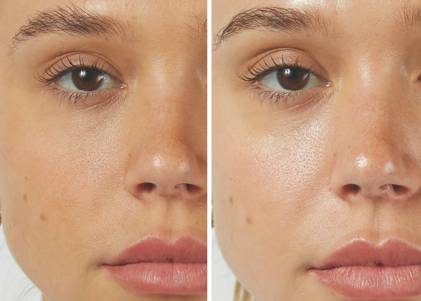 hydrafacial-before-after