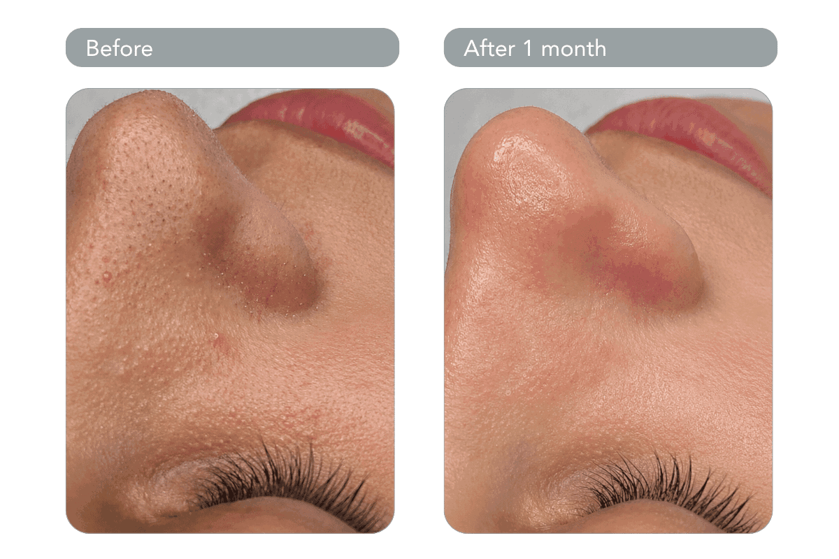 HydraFacial_11_11zon