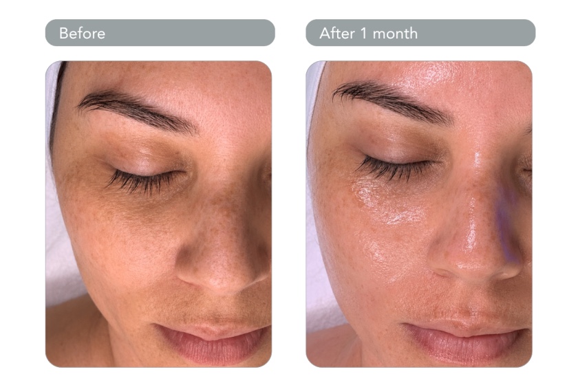 Hydrafacial