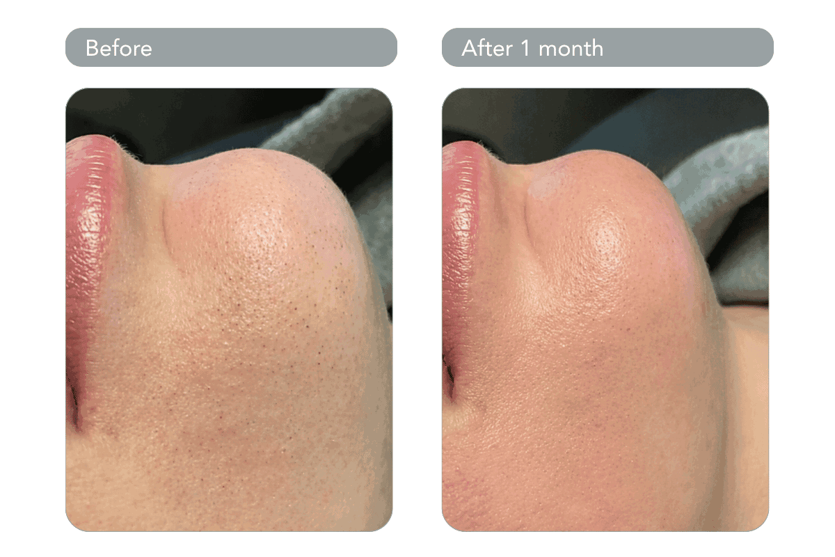 Hydrafacial (2)_10_11zon